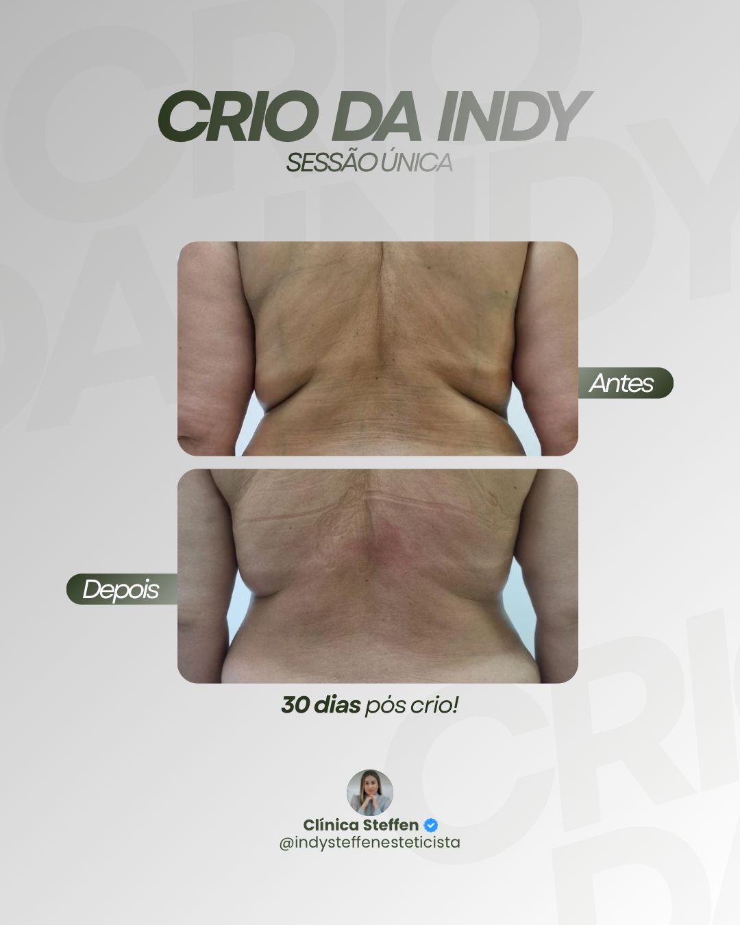 Método Crio da Indi - Caso 1